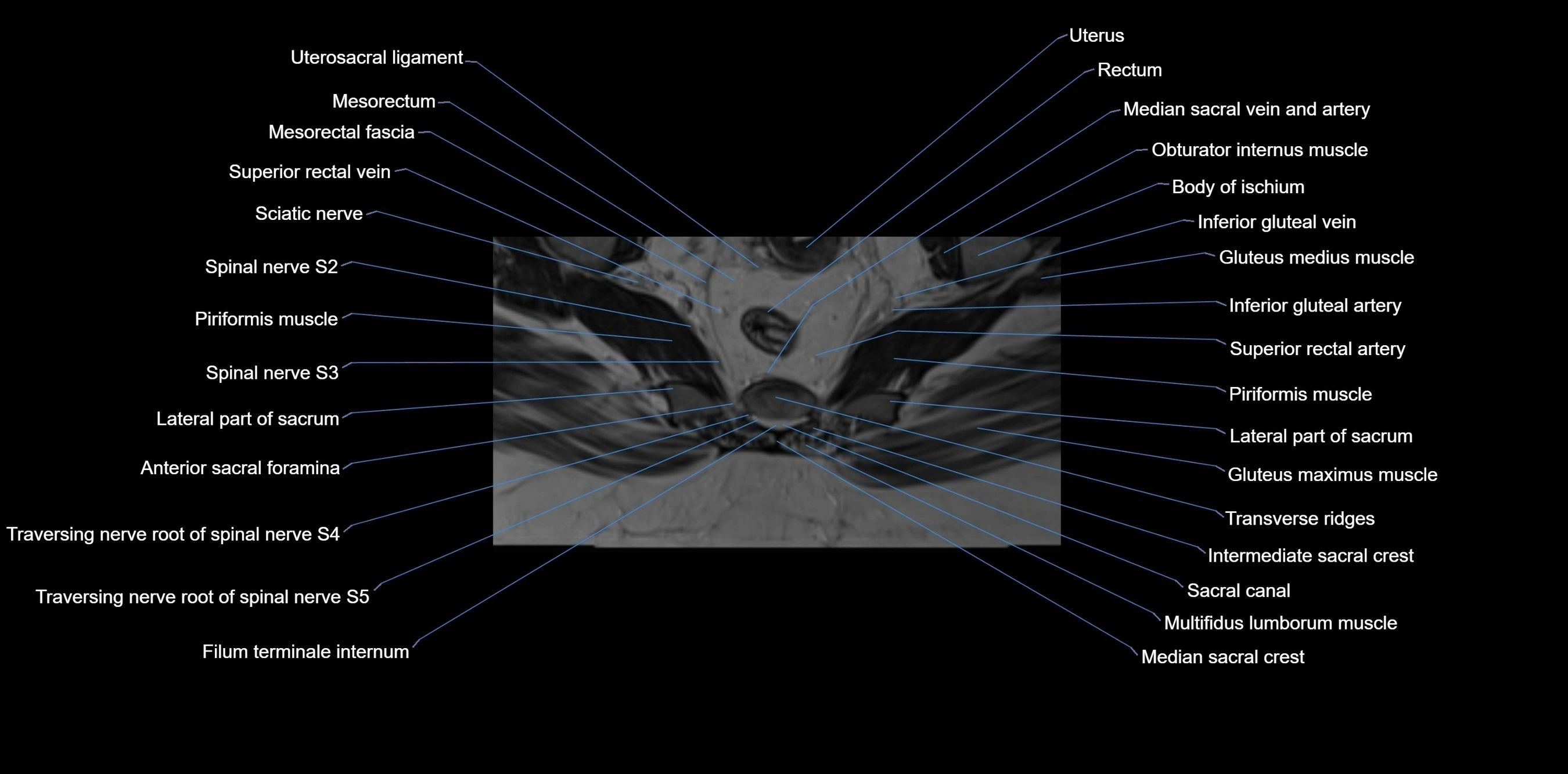 MRI sacrum, coccyx and sacroiliac joint axial cross sectional anatomy 3T  radiology  image-img-00001-00045.webp